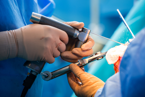 Revision Hip and Knee Surgery